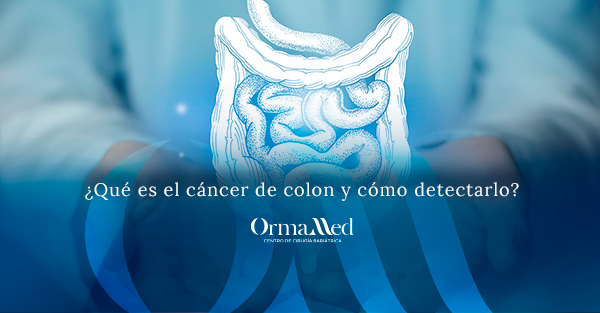 ¿Qué es el cáncer de colon y cómo detectarlo?